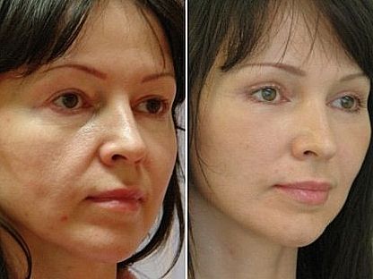 Який результат можна отримати після буккального масажу ліца.фото до і после.буккальний масаж, буккальном масаж обличчя, фото до і після, методика, як проходить процедура, масаж, косметологія, масаж
