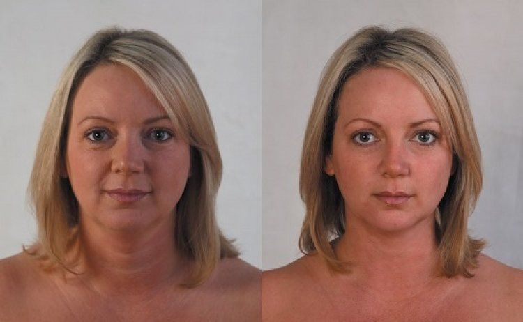 Мезоніті: відгуки, фото до і після підтяжки обличчя, лікування