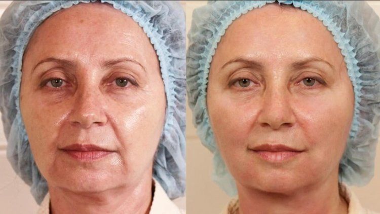 Мезоніті: відгуки, фото до і після підтяжки обличчя, лікування