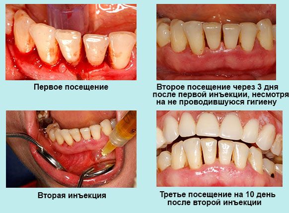 Плазмоліфтінг в стоматології фото до і после.Плазмоліфтінг в стоматології
