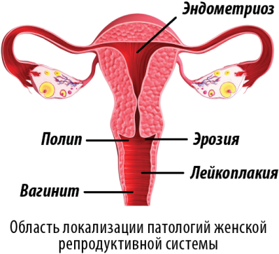 Плазмоліфтінг в гінекології.