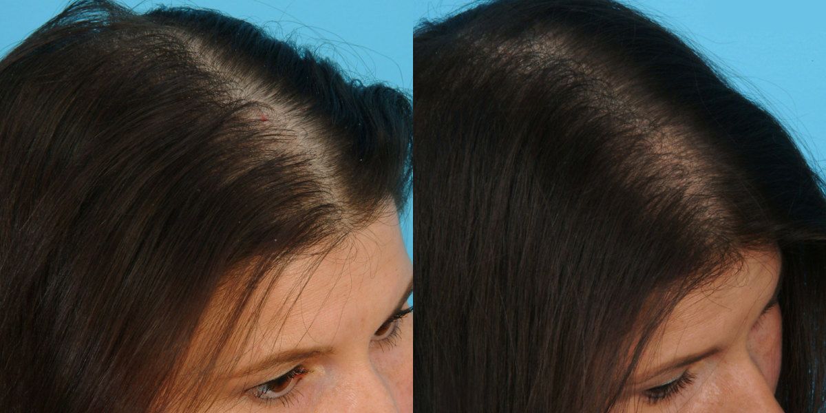 Плазмоліфтінг для волосся фото до і після. Плазмоліфтінг для волосся відгуки