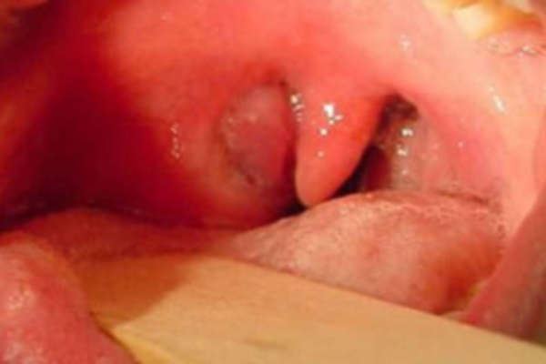 паратонзіллярний абсцес горла лікування
