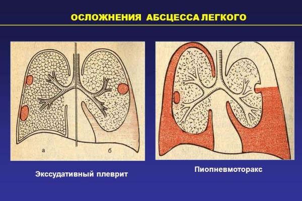 лікування абсцесу легкого антибіотиками