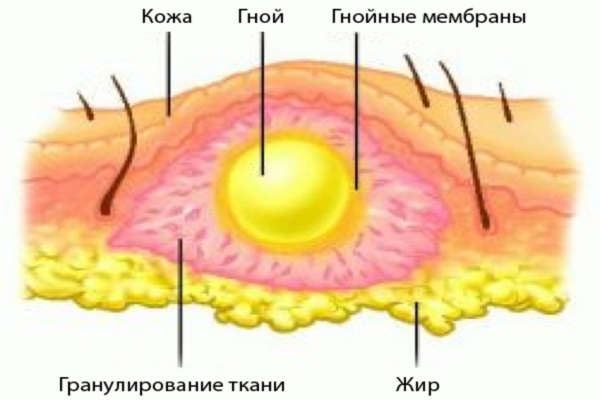 область абсцесу що це