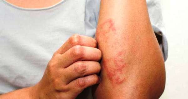 allergicheskij-dermatit-simptomy