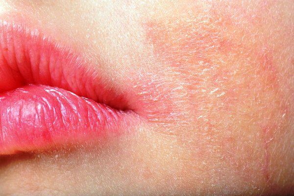 allergicheskij-dermatit-prichiny-simptomy-i-lechenie