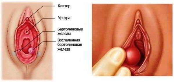 абсцес бартолінової залози