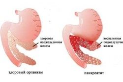 схема панкреатиту
