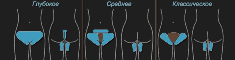 домашня депіляція, зони депіляції, депіляція бікіні, воскова депіляція, цукрова депіляція, ваксинг, шугарінг, депіляція в домашніх умовах
