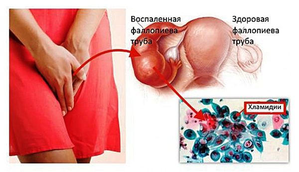 хламідіоз у жінок симптоми і лікування