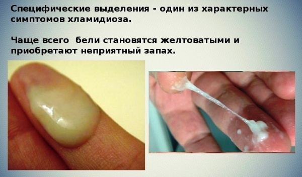 хламідіоз у жінок симптоми