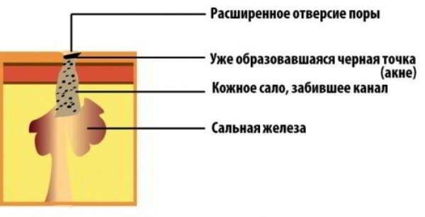 розширені пори шкіри обличчя