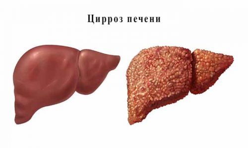 Може бути причиною онкологічних захворювань, виразки або цирозу печінки