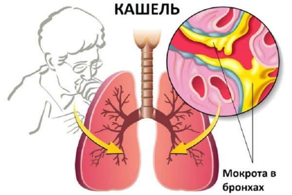 лікування кашлю народними засобами швидко у дорослого при бронхіті форум