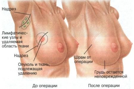 Молитва хвороби молочних залоз