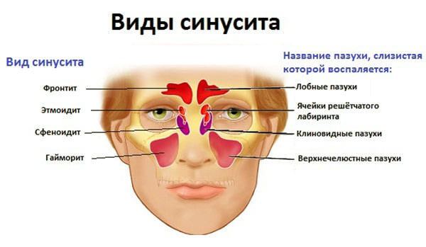 Змова від гаймориту: лікування без проколювання