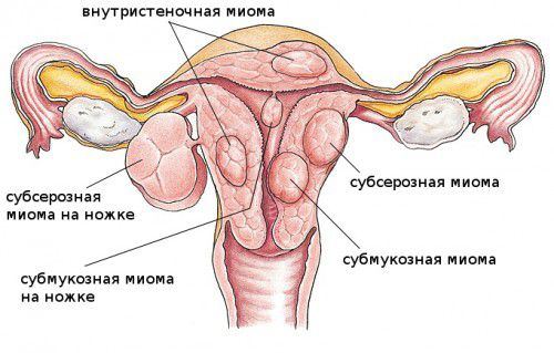 Змова від міоми матки, молитви від жіночих хвороб