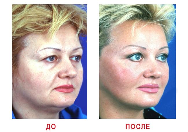 Кругова підтяжка обличчя, підтяжка обличчя, ендоскопічна підтяжка обличчя, підтяжка обличчя відгуки, підтяжка обличчя фото, операція підтяжка обличчя, підтяжка обличчя до і після, ліфтинг обличчя, пластик особа, підтяжка шкіри обличчя, нитки для підтяжки обличчя, обличчя омолодження, шия підтяжки, кругова ендоскопічна підтяжка обличчя
