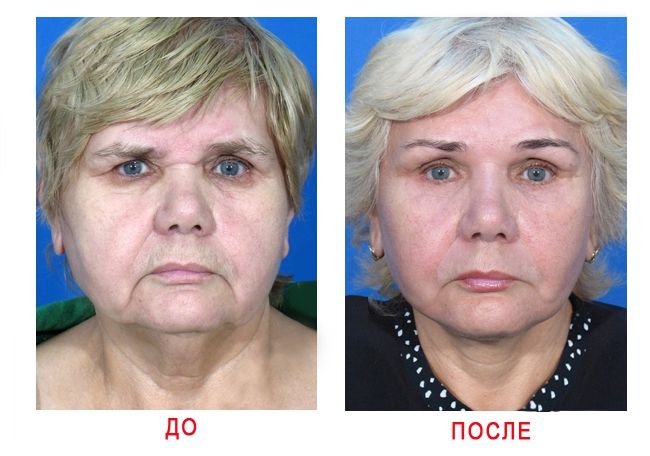 Кругова підтяжка обличчя, підтяжка обличчя, ендоскопічна підтяжка обличчя, підтяжка обличчя відгуки, підтяжка обличчя фото, операція підтяжка обличчя, підтяжка обличчя до і після, ліфтинг обличчя, пластик особа, підтяжка шкіри обличчя, нитки для підтяжки обличчя, обличчя омолодження, шия підтяжки, кругова ендоскопічна підтяжка обличчя