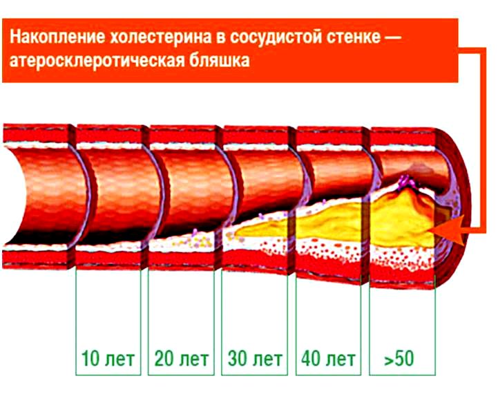 чистка судин