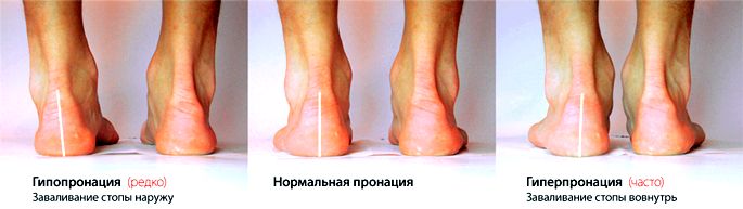 погана стопа