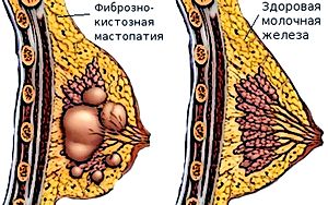 мастопатія