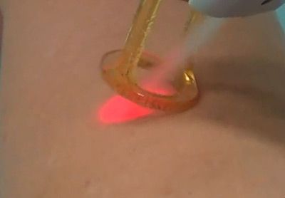 Лазер для шкіри